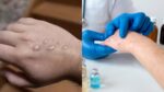 Mpox Virus Outbreak